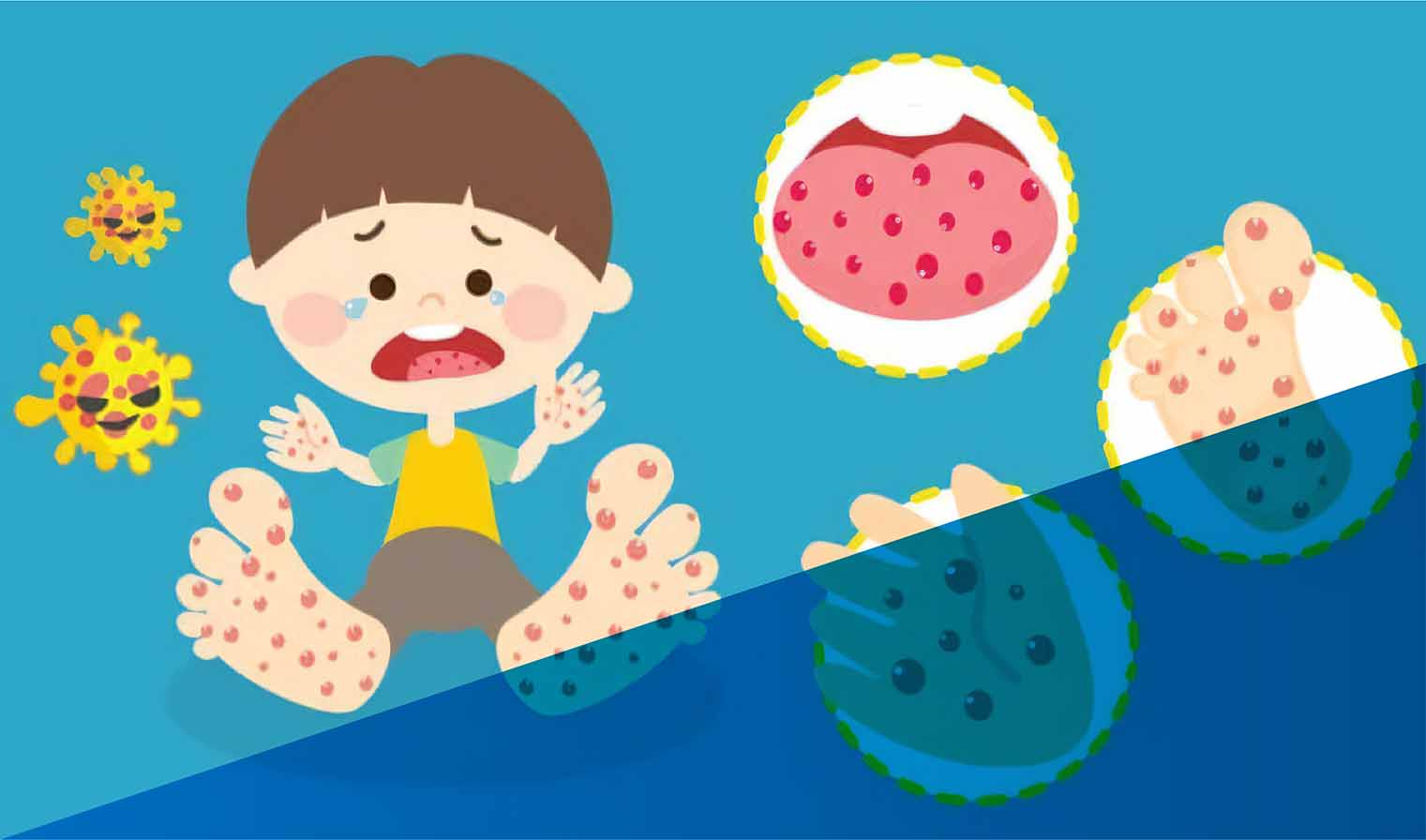 Hand Foot Mouth Disease/ Flu Singapura